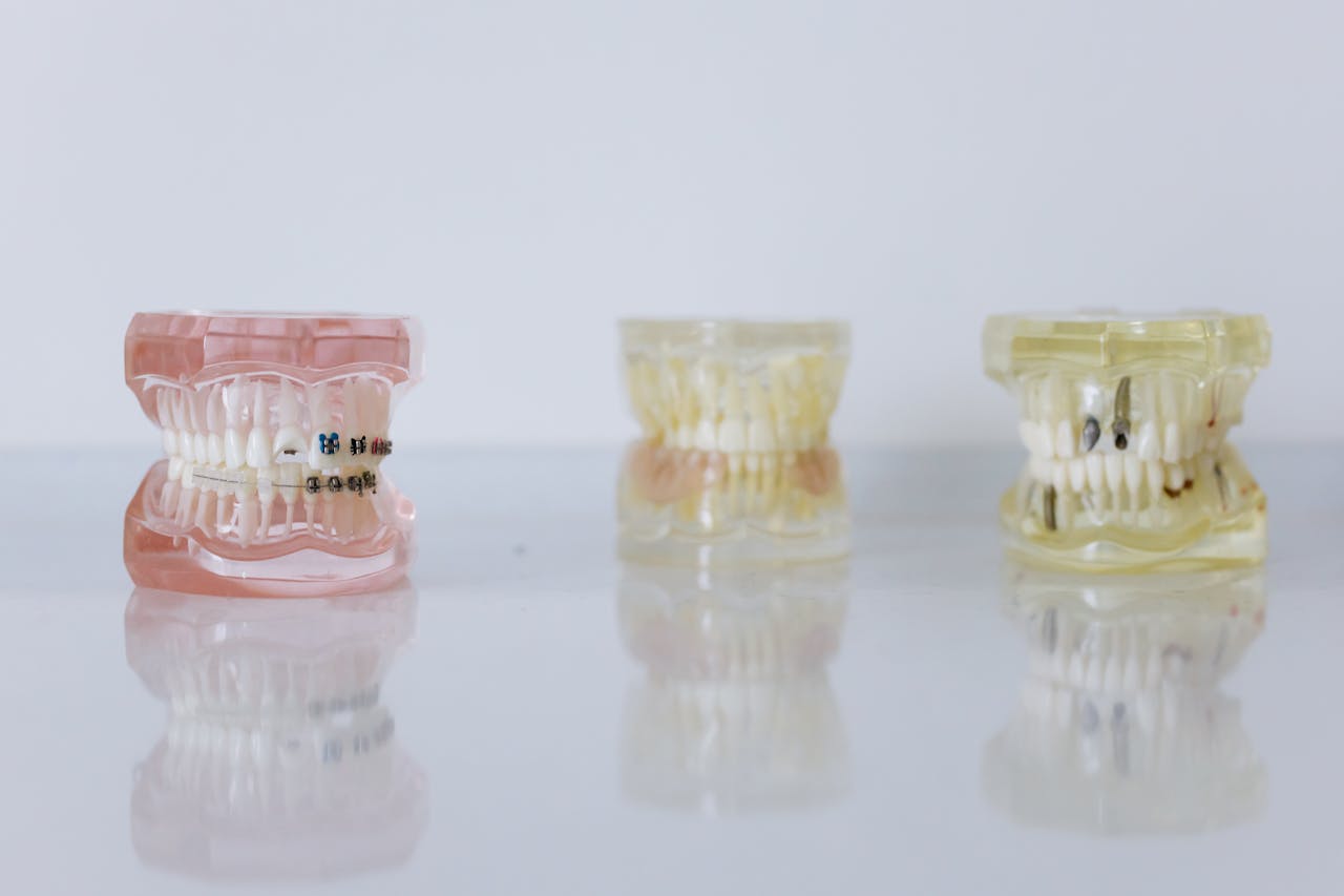 Close-up of dental models displaying braces and dentures for orthodontic education.
